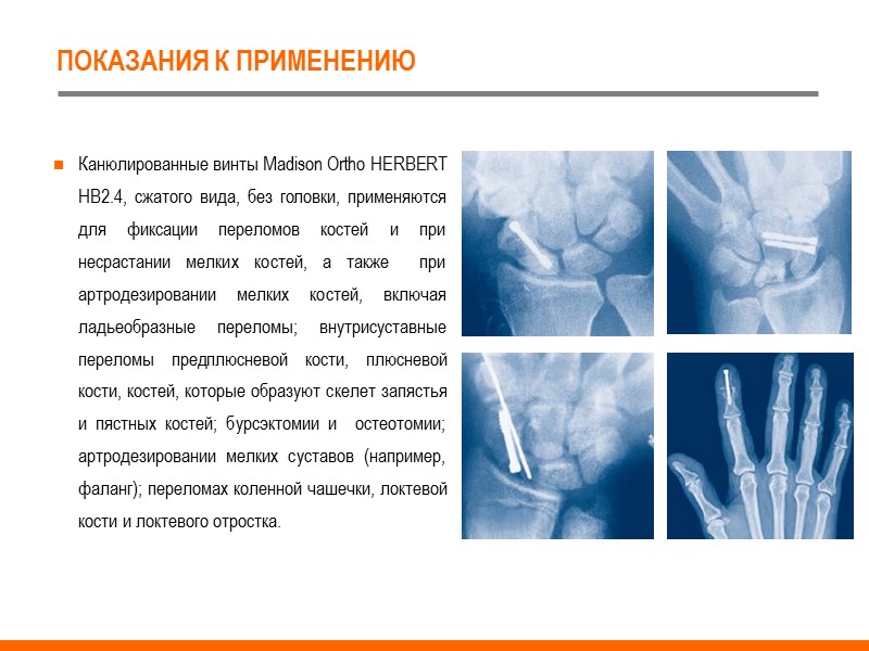 ПОКАЗАНИЯ К ПРИМЕНЕНИЮ Канюлированные винты Madison Ortho HERBERT HB2.4, сжатого вида, без головки, применяются